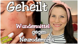 Neurodermitis  Ich wurde komplett geheilt  Wundermittel [upl. by Obadiah]