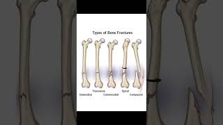 Types of bone fractures osteology osteoporosis bones bone anatomy trending viralvideo [upl. by Dorene]