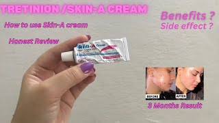 Skin A Cream Review  Acne Treatment at home  How to Use Tretinoin  Tretinoin Cream [upl. by Adine]