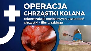 Operacja chrząstki kolana  film z zabiegu  Nowa Ortopedia [upl. by Llain570]