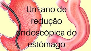 Um ano de gastroplastia endoscópica [upl. by Ruth]