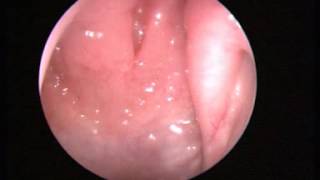 Video 1 Normal nasal endoscopy [upl. by Latsyrhc873]