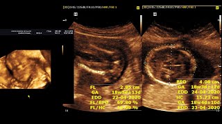 Ultrasound cases 130 of 2000  Video Showing 18wks of normal pregnancy [upl. by Esiocnarf574]