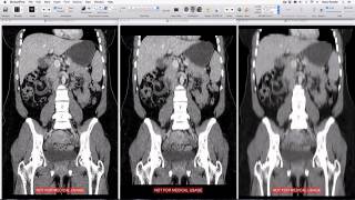 How to optimise CT series for teaching using OsiriX Lite [upl. by Novled]