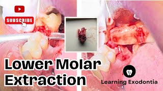 lower molar extraction  molar extraction  mandibular molar extraction dentistry dentist dental [upl. by Derayne]