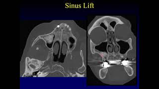 Imaging of the Paranasal Sinuses 5 [upl. by Saunder850]