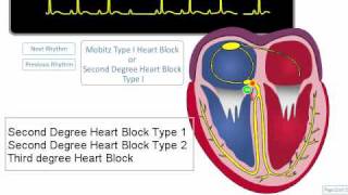 ECG Rhythm Review AV Blocks [upl. by Amsirac]