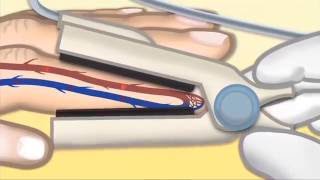 Pulse Oximetry by T Wolbrink  OPENPediatrics [upl. by Fennell]