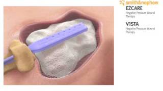 Negative pressure wound therapy from smith and nephew [upl. by Yetty]