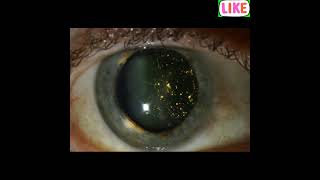 Asteroid Hyalosis disease healthcare health disorder eyediseases eyedisease eyesighttreatment [upl. by Ahsie]