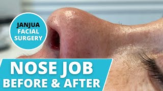 NOSE JOB BEFORE AND AFTER COLUMELLAR REDUCTION  DR TANVEER JANJUA  NEW JERSEY [upl. by Holmann]