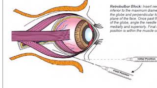 Retrobulbar block in dog prior to enucleation [upl. by Trojan799]