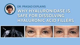 How Hyaluronidase Injections to Remove Filler is Done Safely [upl. by Primaveria59]