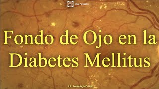 Clase de Fondo de Ojo en la Diabetes Mellitus Retinopatía Diabética [upl. by Hulbard]