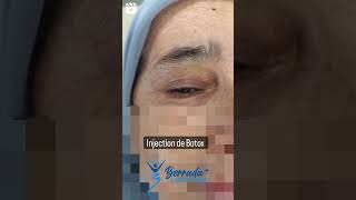 Injection de Botox blepharospasme mouvements involontaires du muscle des paupières [upl. by Adnima390]