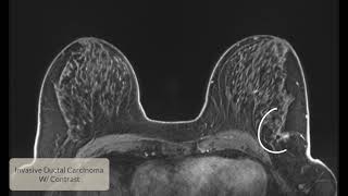 Invasive Ductal Carcinoma [upl. by Ahsille]