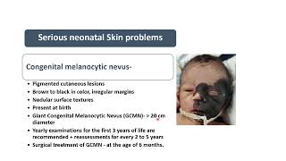 Congenital Melanocytic Nevus  Spot Diagnosis 27  Pediatrics [upl. by Kinghorn]