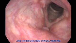 01 laryngeal activity before manipulation [upl. by Ahders]