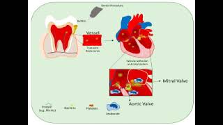 BACTERIAL ENDOCARDITIS AND PROPHYLAXIS IN DENTISTRY [upl. by Caines]