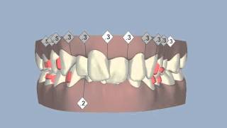 Clincheck  a 3d image of how your teeth could look at the end of invisalign treatment [upl. by Corron]