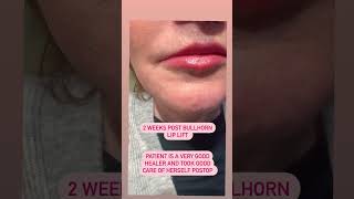 Stunning Bullhorn Lip Lift Transformation 2 Weeks PostOp [upl. by Adnilram758]