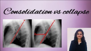 Chest X ray  How to differentiate consolidation from collapse [upl. by Eelyram]