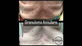 Granuloma Annulare [upl. by Ruenhs782]