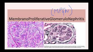 Membranoproliferative Glomerulonephritis MPGN [upl. by Bronwyn]