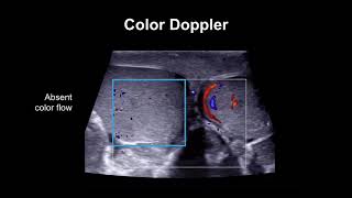 Diagnosing testicular torsion [upl. by Weingarten]