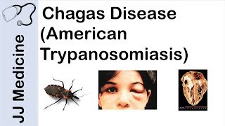 Chagas Disease  American Trypanosomiasis  Causes Symptoms and Treatment [upl. by Aicnarf]