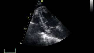 CHRONIC PERICARDITIS with thickening of the pericardium [upl. by Ellenar163]