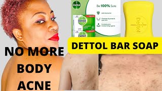 How To Use Dettol Antiseptic Bar Soap To Clear Body Acne And Rashes For Good [upl. by Yltsew286]