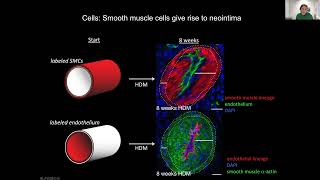 Single Cell Approaches to Understand Neointimal Lesion Formation amp Growth in Pulmonary Hypertension [upl. by Rexanne]