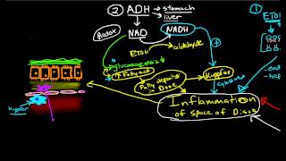 Pathophysiology of Cirrhosis [upl. by Madea483]