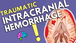 Intracranial Hemorrhage [upl. by Siramad562]