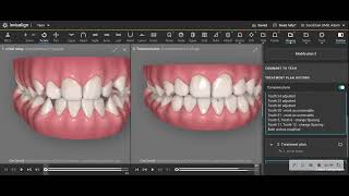 For Orthodontists Modifying a Clincheck using your knowledge of how teeth move [upl. by Neelik]