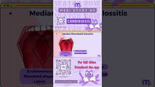 Median Rhomboid Glossitis  Oral Medicine  Medi Study Go [upl. by Anilat129]