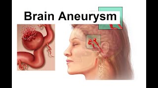 Brain Aneurysm Pathology  Etiology  Pathogenesis  Clinical manifestations  Diagnosis amp Treatment [upl. by Strauss717]