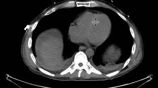 Hematoma with active extravasation [upl. by Eanert]