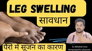 Best Homeopathic Medicine For Oedema How To Rid Of Swelling Easily ।2024👇 [upl. by Nyraa651]