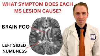 What Symptom Does Each Multiple Sclerosis MRI Lesion Cause Neurologist Explains [upl. by Coheman]