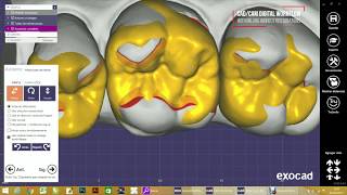 Flujo de trabajo digital para incrustaciones dentales [upl. by Renae]