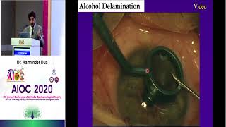 Alcohol Delamination procedure [upl. by Euqirne]