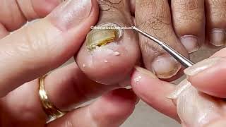 Pedicure Toenail Cleanings part 2 [upl. by Nashbar952]