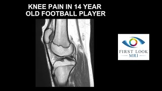 Knee pain in 14 year old football player [upl. by Pansie653]