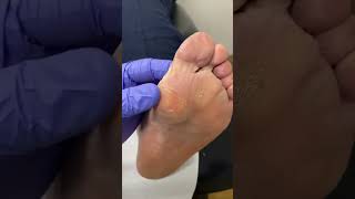 Experience satisfying relief with this Aussie podiatrists bunion callus removal [upl. by Geiger]