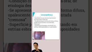 Características Clínicas do Leucoedema  Resumo Patologia Bucal  Concurso Odontologia [upl. by Llerret125]