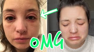 ALLERGIC REACTION  SWOLLEN EYES  ECZEMA FLARE UP  INFECTED ECZEMA [upl. by Ayn]