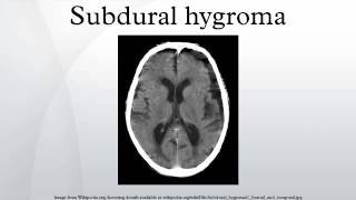 Subdural hygroma [upl. by Lindblad]