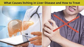 What Causes Itching in Liver Disease and How to Treat  Nuse Healthy [upl. by Nehtiek]